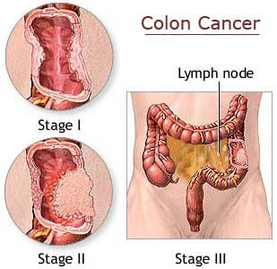 Colon Cancer Symptoms