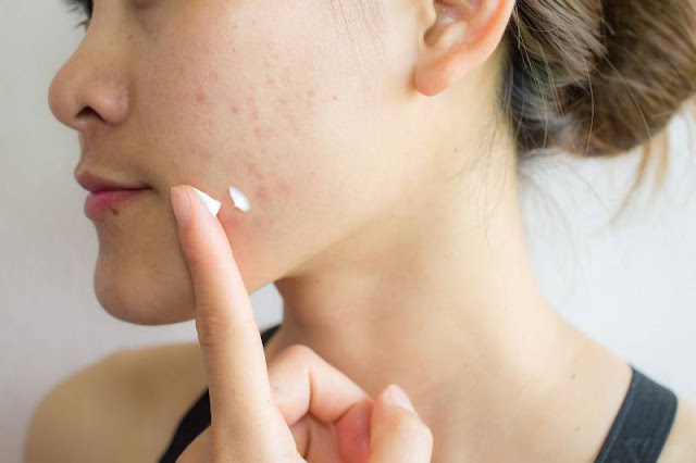 Pakai Acne Spot Gel yang Bisa Mengurangi Inflamasi