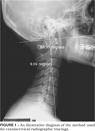 lateral neck x-ray