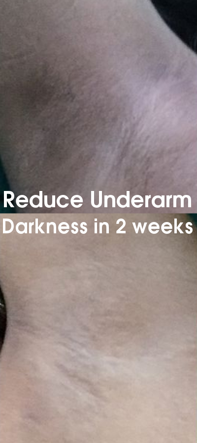 Reduce Underarm Darkness in 2 weeks