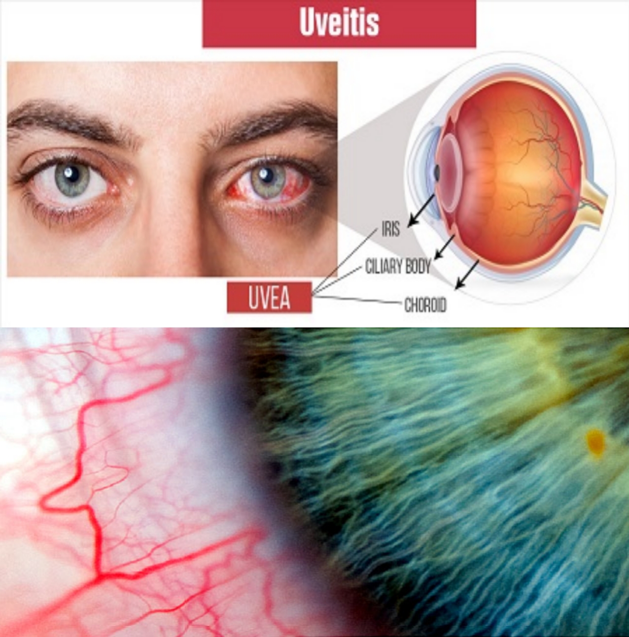 uveitis causes and treatment, Uveitis - Know the causes and Treatment
