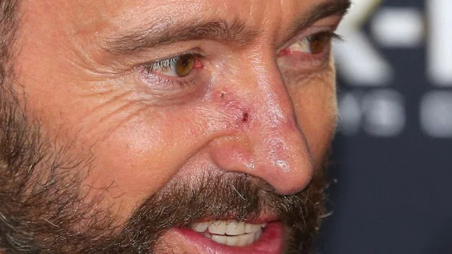 Βασικοκυτταρικό καρκίνωμα. Καρκίνο του δέρματος είχε στην μύτη του ο ηθοποιός Hugh Jackman (φωτο)