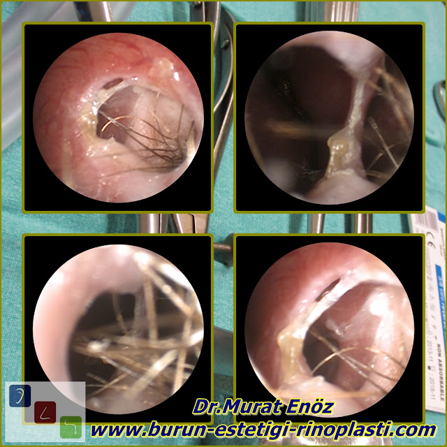 Septum perforasyonu tanımı - Septum perforasyonu  nedenleri - Septum perforasyonu belirtileri - Septum perforasyonu tedavisi - Açık teknik septum perforasyonu ameliyatı - Açık teknik septum perforasyonu onarımı - Burun duvarında delik