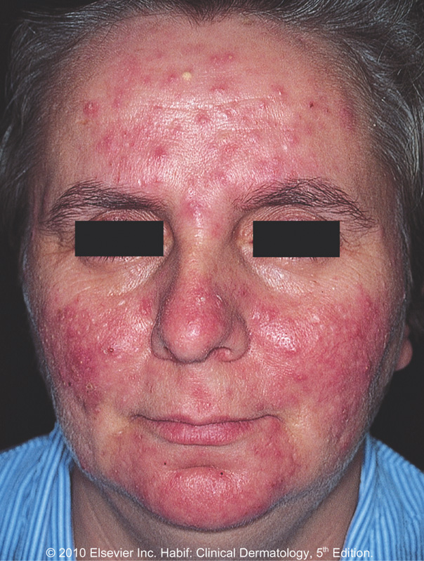 Are There Any Natural Remedies For Rosacea