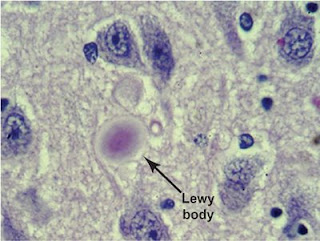 brain cells showing Lewy body