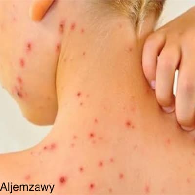 Chickenpox: symptoms, treatment and prevention