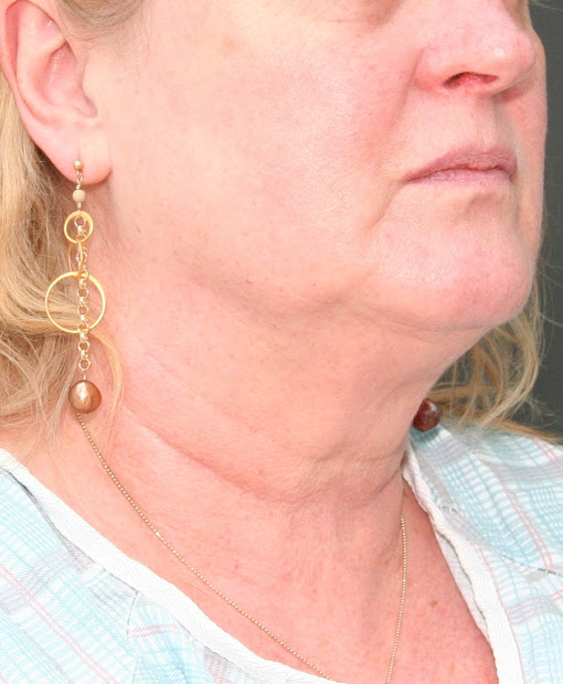 Hairstyles To Camouflage Jowls Vtwctr