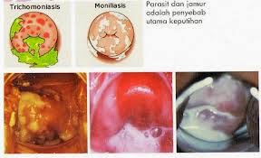 Keputihan Pada Wanita