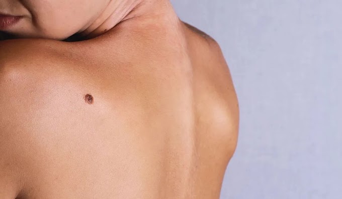  Καρκίνος δέρματος: 7 μύθοι που καταρρίπτει η επιστήμη