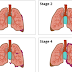 Mesothelioma Staging