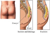 sinus pilonidal kyste sacro-coccygien