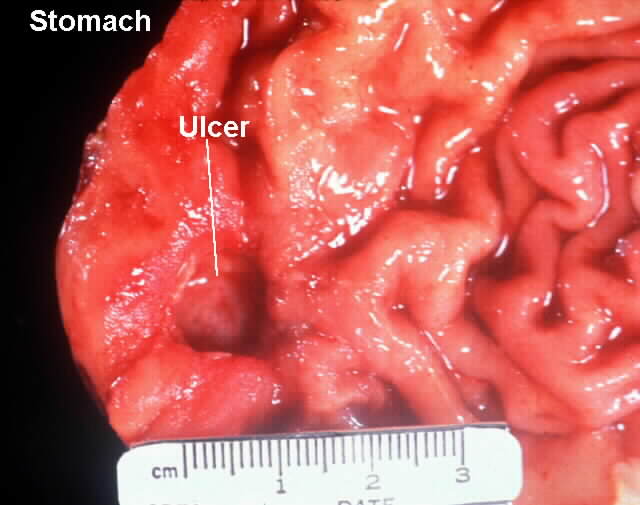 Gastric Ulcer Pictures Part 1 