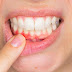 Sưng nướu răng là bệnh gì? 