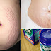 How To Use Vicks Vaporub To Get Rid Of Accumulated Belly Fat, Eliminate Cellulite And Have Firmer Skin