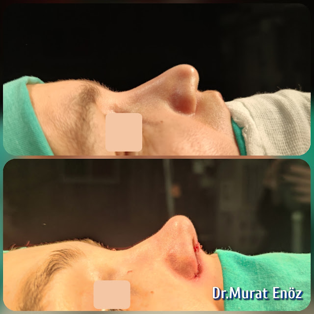 Augmentation rhinoplasty, Altering the nose size, Increasing the nose volume