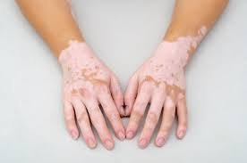 Vitiligo treatment