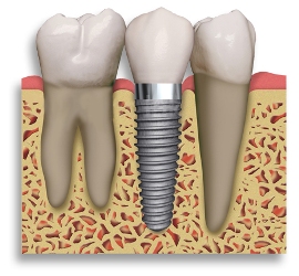 tooth-implant