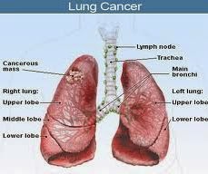 pengobatan alternatif kanker Paru paru, obat kanker paru, pengobatan kanker paru