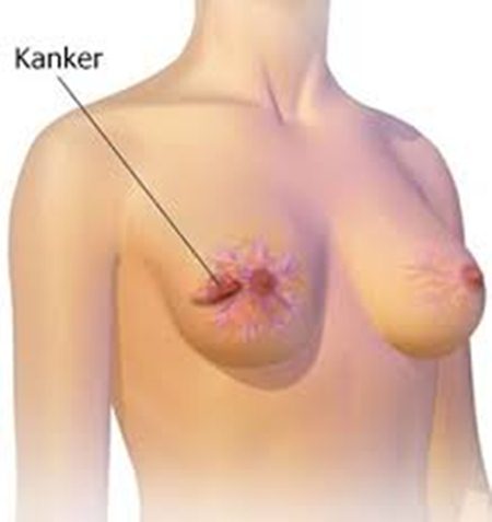 Kanker payudara bisa menyusui, obat alami untuk pencegahan kanker payudara, sembuh dari kanker payudara stadium 4, kanker payudara pembunuh nomor satu, yayasan kanker payudara jakarta, kanker payudara menurut ustad danu, kanker payudara pria, obat kanker payudara stadium empat, gejala kanker payudara nyeri, kanker payudara stadium 3 bisa sembuh, kanker payudara pada lelaki