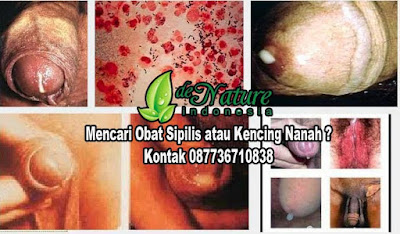 Mengobati Sipilis Dengan Cepat Dan Aman Dengan De Nature