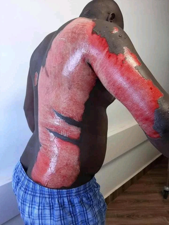 a guy burnt by his wife in Kenya
