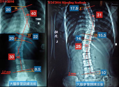 脊椎側彎, 脊椎側彎背架, 脊椎度數,脊椎側彎矯正, 脊椎側彎治療, 脊椎側彎矯正成功案例, 脊椎側彎 復健