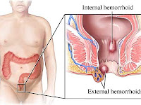 Pengobatan Untuk Ambeien Atau Wasir