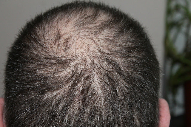 10 best natural supplements for hair loss