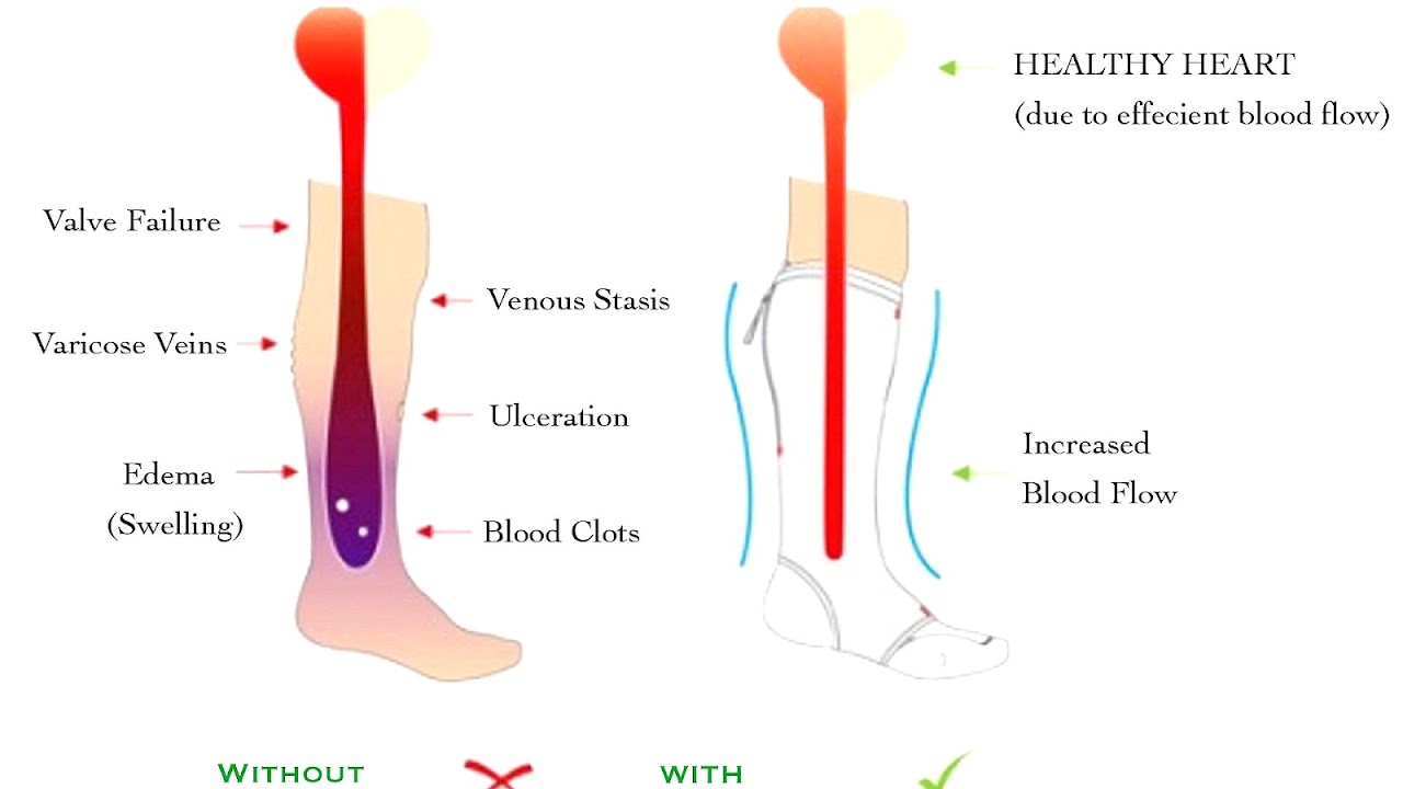 Compression Socks For Swollen Feet