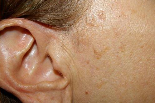 file:Seborrheic Keratosis Causes Symptoms And Treatment.svg