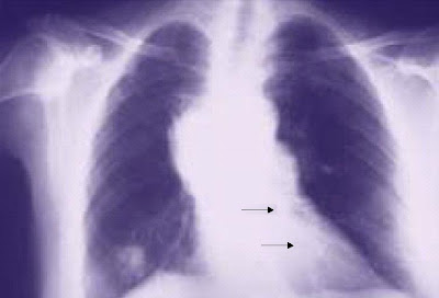 Radiografía que muestra áreas de neumonía (flechas)