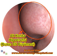 Burun etlerini büyümek zorunda bırakmayın! - Burun eti ameliyatı sonrasında, burun etleri neden yeniden  büyüyebilir? - Burun eti küçültülmesi için en ideal yöntem hangisidir? -  Lazerle burun eti ameliyatı mümkün müdür? - Burun etlerinin büyümemesi için önlemler