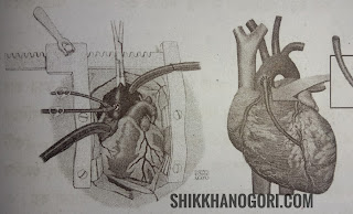 ওপেন হার্ট সার্জারি কি শিক্ষানগরী Open Heart Surgery On pump surgery Off pump surgery or Beating heart Minimally invasive Robot-assisted surgery