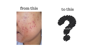 acne story