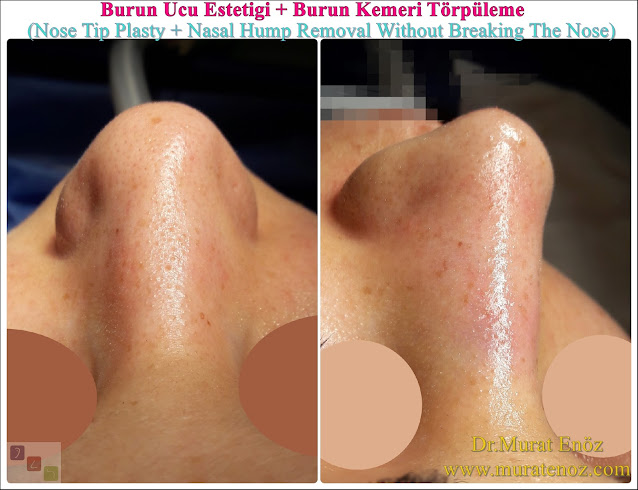 Burun Ucu Estetiği + Burun Kemeri Törpüleme (Nose Tip Plasty + Nasal Hump Removal Without Breaking The Nose)