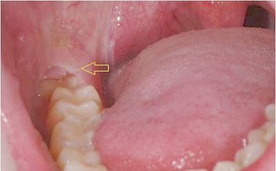 Thắc mắc ăn gì sau khi nhổ răng khôn?