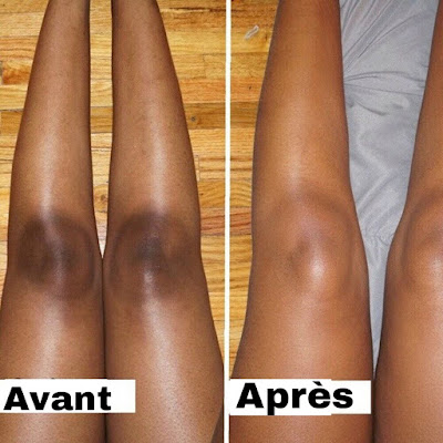 Éclaircir la peau des genoux foncés avec des recettes naturelles
