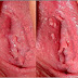 Ciri Pria Terkena Virus Hpv thumbnail