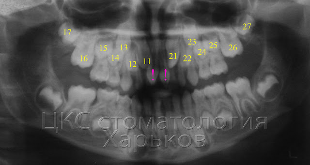 Рентген сверхкомплектных зубов