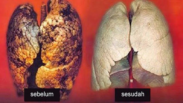 Cara Membersihkan Paru-Paru