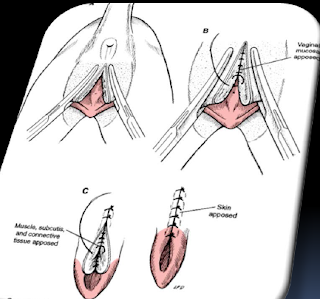 Teknik Operasi Episiotomy pada Hewan (Bedah Genitalia)