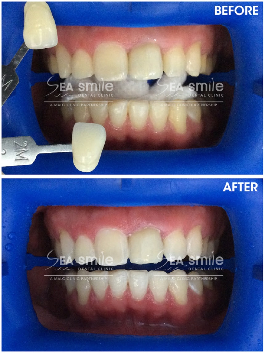 Laser Teeth Whitening Cost Australia - TeethWalls