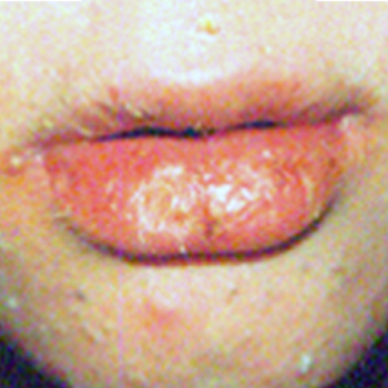 If the split lip is from a fall, a warm, saltwater rinse will help flush out any dirt and debris. Accutane Lips Accutane Patients Dr Dan S Lip Balm