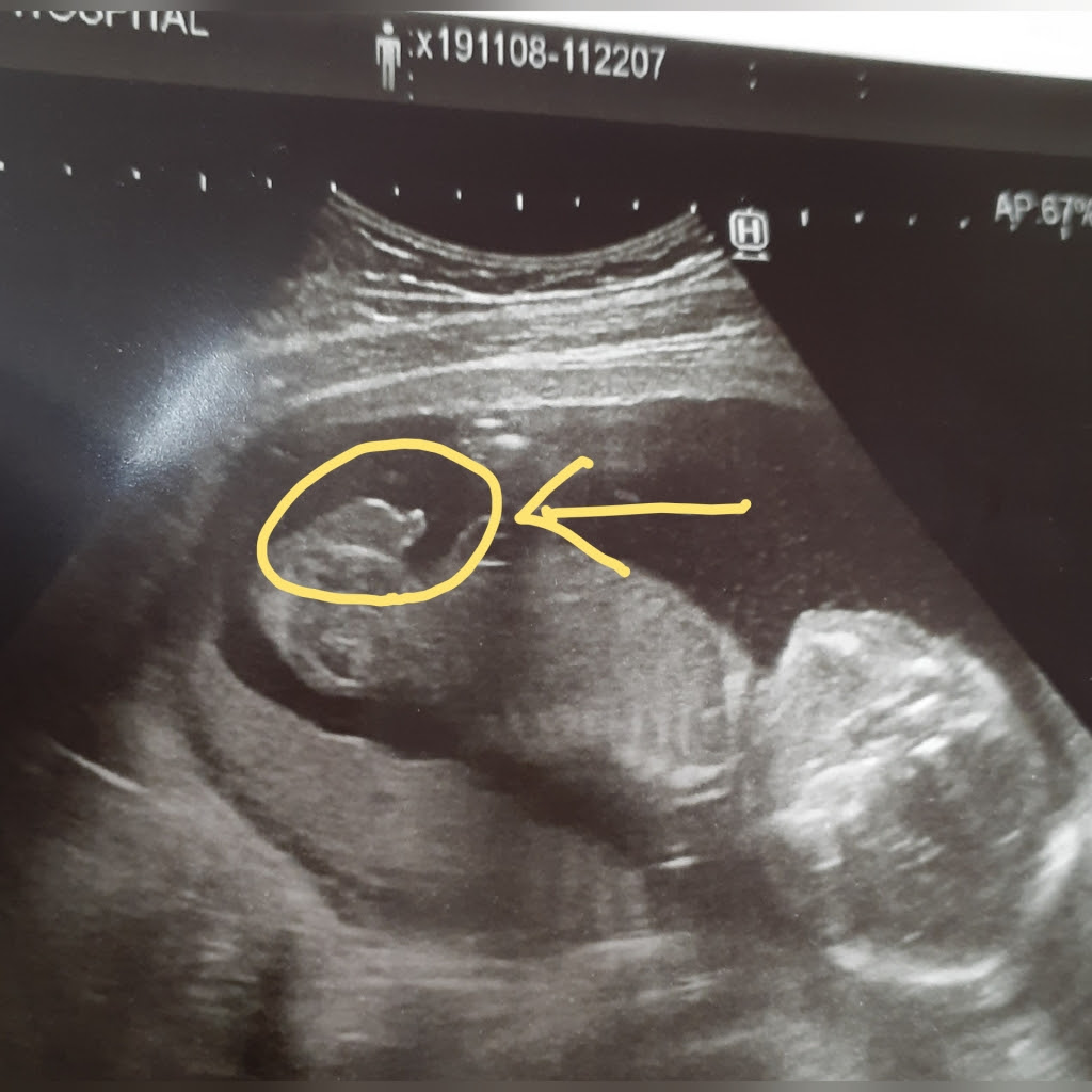 イメージカタログ 驚くばかり 妊娠 14 週 性別