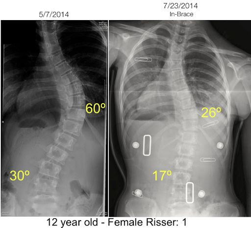 Já escoliose não estrutural é causada pela discrepância dos membros inferiores, espasmo ou dor nos músculos da coluna vertebral, por compressão de raiz nervosa ou qualquer outra lesão na coluna, podendo ainda ser causada pelo mau posicionamento do tronco (kisner e colby, 2004). Escoliose Artigo Completissimo Sobre Esse Desvio Na Coluna Ortopedia Br