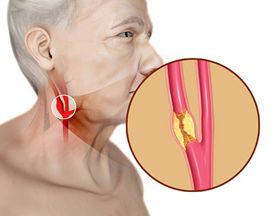 /kəˈrɒtɪd/) are arteries that supply the head and neck with oxygenated blood; Carotid Artery Disease Treatment Sydney Cad Sydney