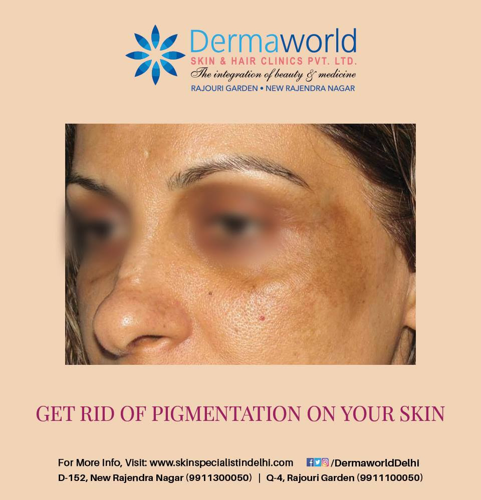 The dark pigmentation on face can ruin a person's appearance as the face looks blotchy and uneven. Get Rid Of Pigmentation On Your Skin Skin Specialist In Rajendra Nagar