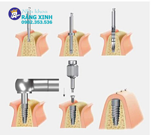 cấy implant tại tp vinh