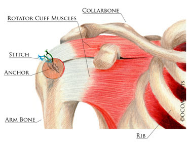 A muscle gets strained when it is stretched too much. Rotator Cuff Tear Orlin Cohen
