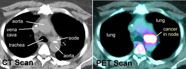 Pet scan is a type of test that may be used in cancer treatment. Pet Scans In Cancer Cases